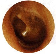 Turn on graphics to view Betty's tympanic membrane