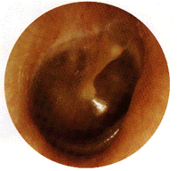 Turn on graphics to view Betty's tympanic membrane